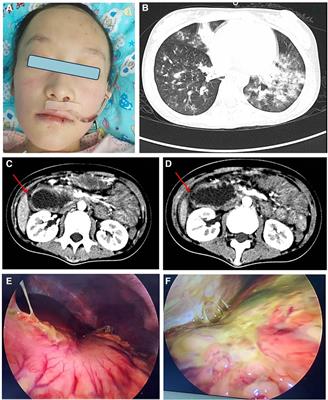 Juvenile dermatomyositis complications: navigating gastrointestinal perforations and treatment challenges, a case report
